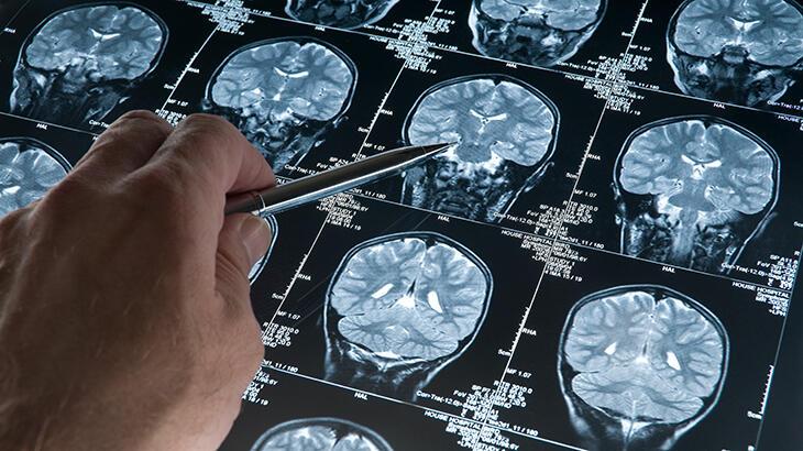 Alzheimer'da çok çarpıcı koronavirüs detayı! Sakın bu soruları sormayın