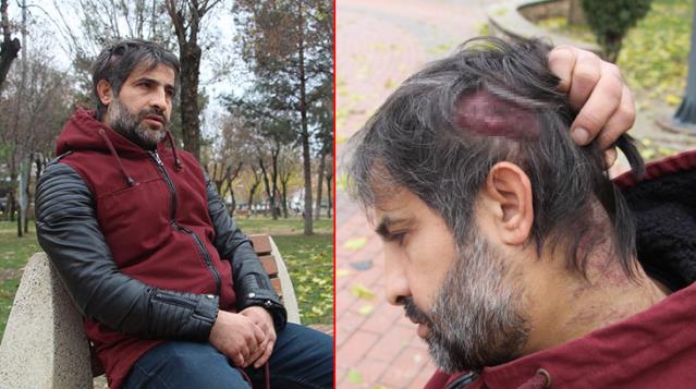 Kafasında çıkan kist hayatını kabusa çevirdi! 5 çocuklu babanın hastalığına 12 yıldır teşhis konulamıyor