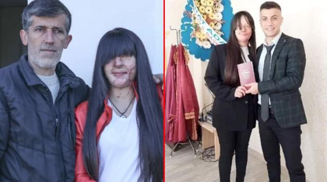 Yüzünü asitle yakan sevgilisiyle evlenen Berfin'in babasından sert tepki: Onu öldürmek isteyen adamla nasıl evlenir
